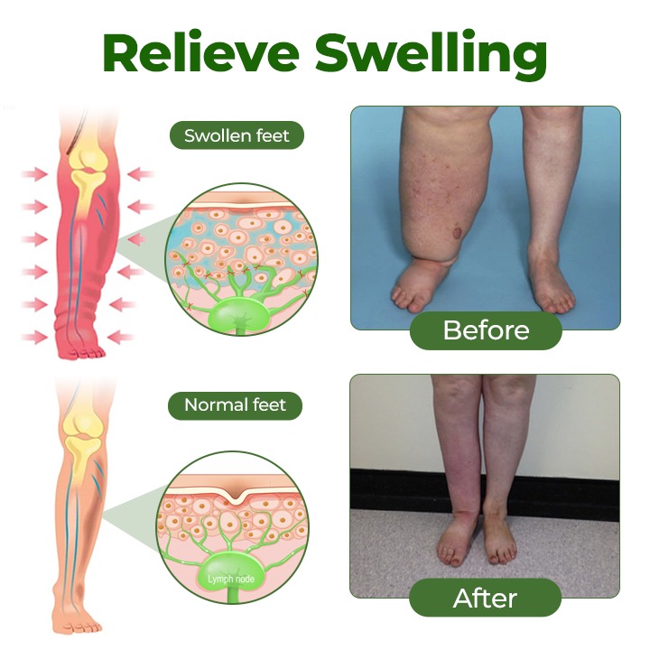 🔥 BUY 1 GET 1 FREE Professional Leg Circulation Cream – Soothe Swelling & Heavy Legs 🦵