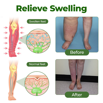 🔥 BUY 1 GET 1 FREE Professional Leg Circulation Cream – Soothe Swelling & Heavy Legs 🦵