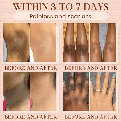 Cougex® Purifying Exfoliating Gel for Acanthosis Nigricans, Exfoliation, Dark Spots, Skin Tags, and Eczema 🎁