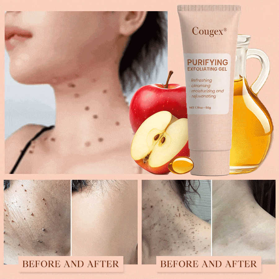 Cougex® Purifying Exfoliating Gel for Acanthosis Nigricans, Exfoliation, Dark Spots, Skin Tags, and Eczema 🎁