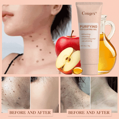Cougex® Purifying Exfoliating Gel for Acanthosis Nigricans, Exfoliation, Dark Spots, Skin Tags, and Eczema 🎁