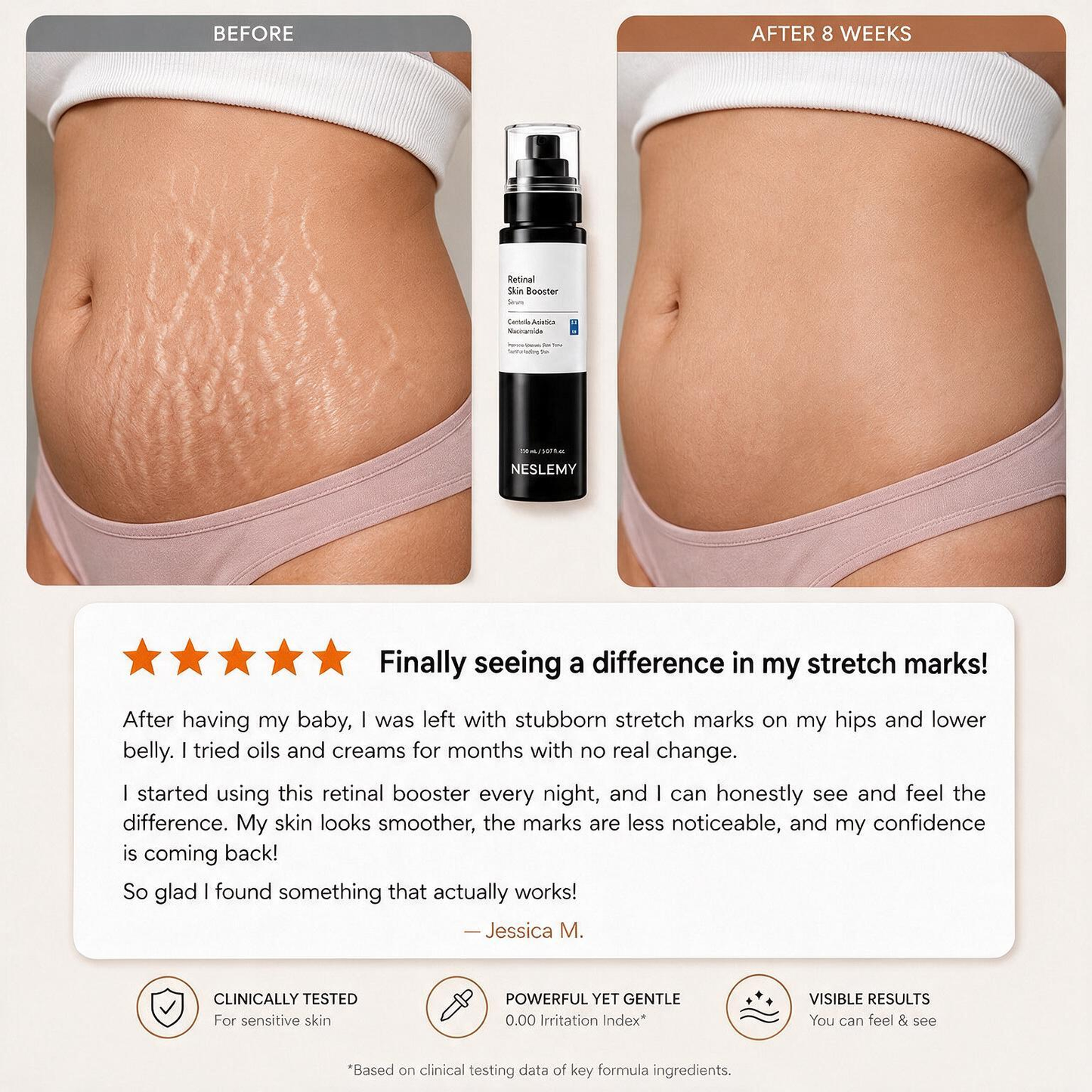 💥70K+ SOLD💕NESLEMY® Advanced Retinal Stretch Mark Serum — Pregnancy, Growth & Weight-Change Care