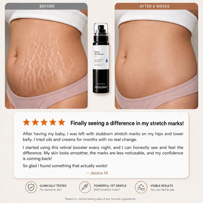 💥70K+ SOLD💕NESLEMY® Advanced Retinal Stretch Mark Serum — Pregnancy, Growth & Weight-Change Care