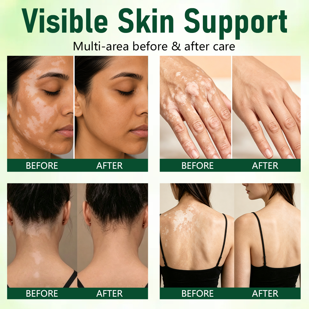 Last day Buy 1 Get 1 Free🔥NESLEMY® Herbal Vitiligo Cream