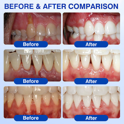 Buy 1 Get 1 Free🦷Periodontal Repair Gel