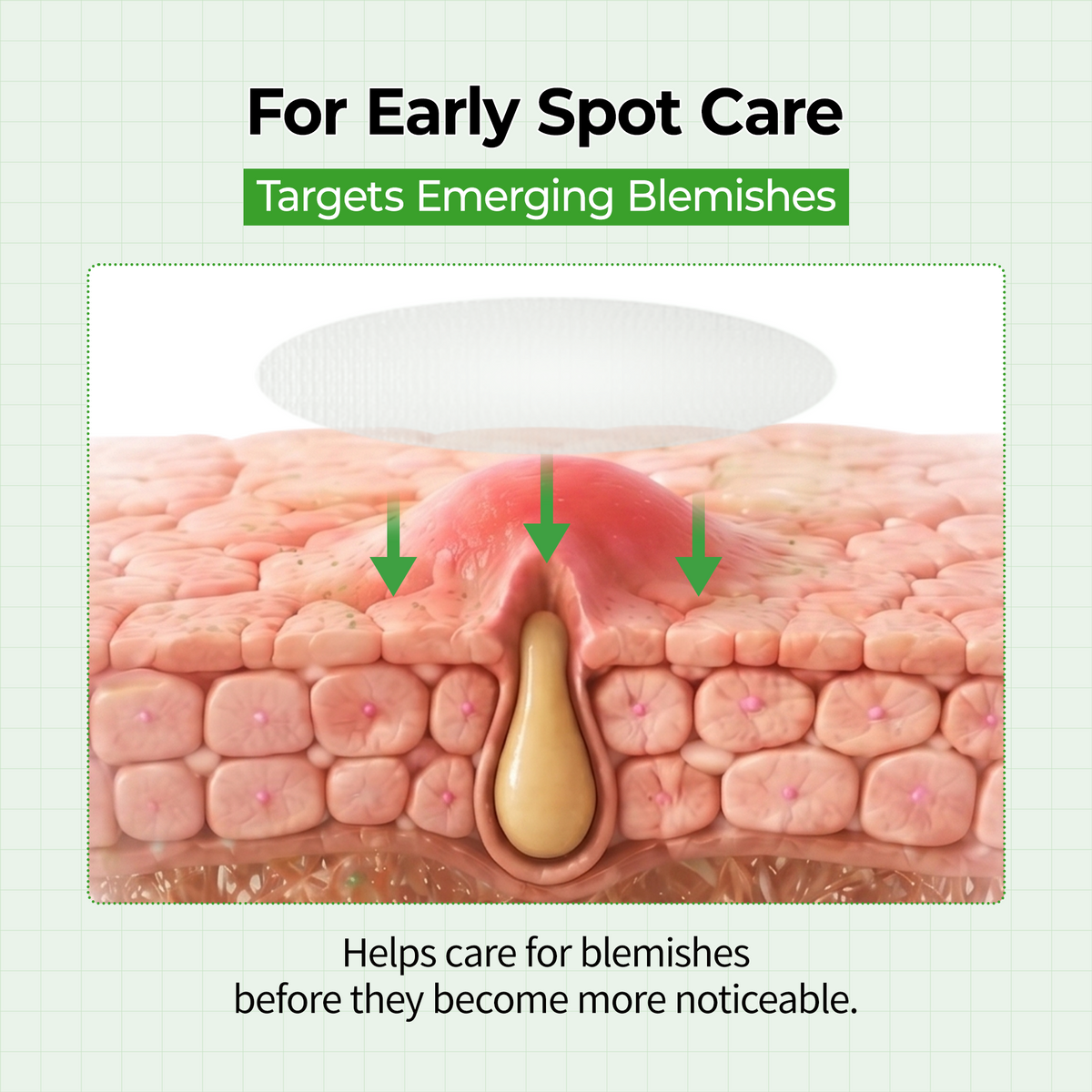 🔥LAST DAY Buy 1 Get 1 Free🔥S-ZINC CLEAR-SKIN Ultra Thin Blemish Spot Patch